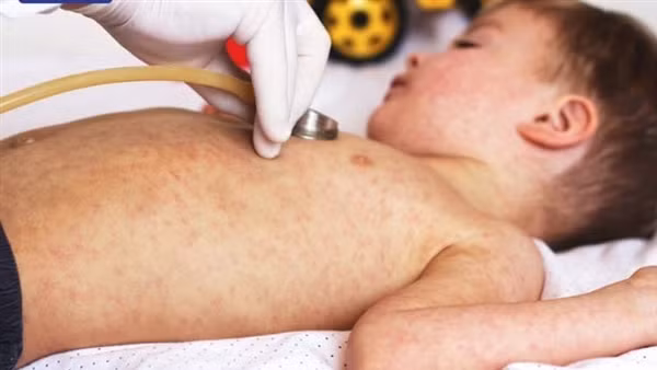 Phân bổ vaccine sởi đợt 2 cho 54 tỉnh, kết thúc tiêm chủng vào cuối tháng 3