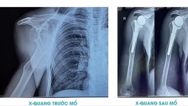 Lần đầu tiên Bệnh viện 199 thực hiện thành công phẫu thuật thay khớp vai toàn phần đảo ngược