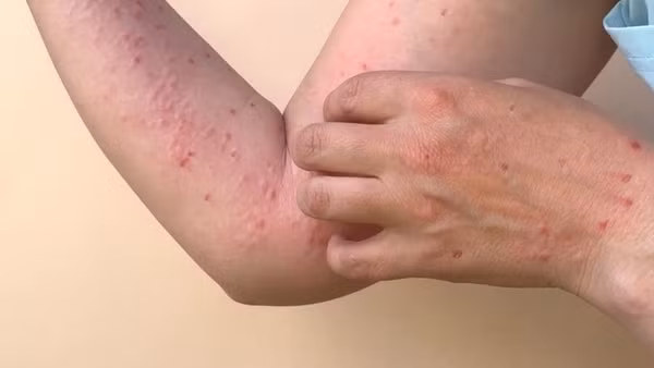 Bệnh nhân mắc đậu mùa khỉ đã có kết quả xét nghiệm âm tính