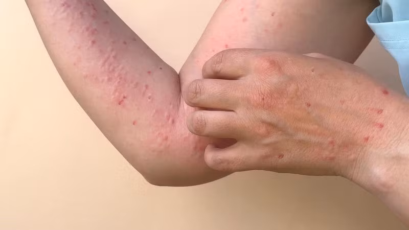 Bệnh nhân mắc đậu mùa khỉ đã có kết quả xét nghiệm âm tính&nbsp; -0