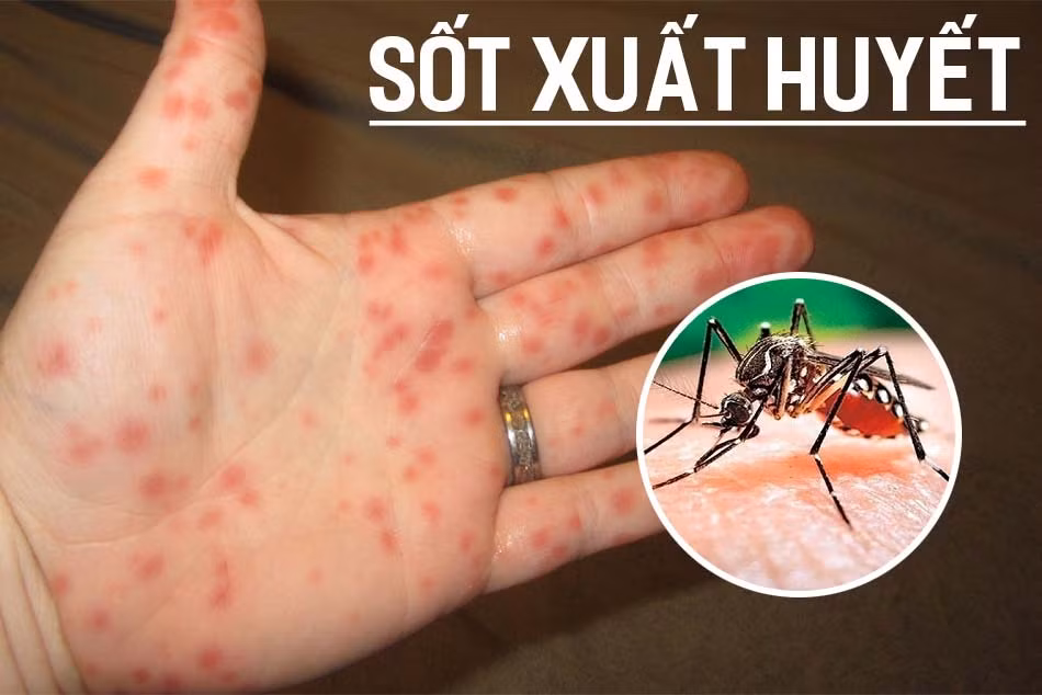 Đã có 93.000 người mắc sốt xuất huyết, 36 ca tử vong -0