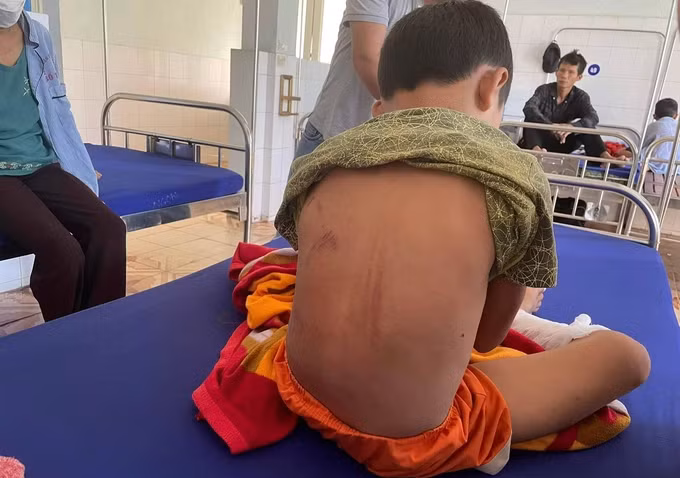 Cháu bé bị bỏng nặng do cha ruột dùng xăng và rơm đốt -0