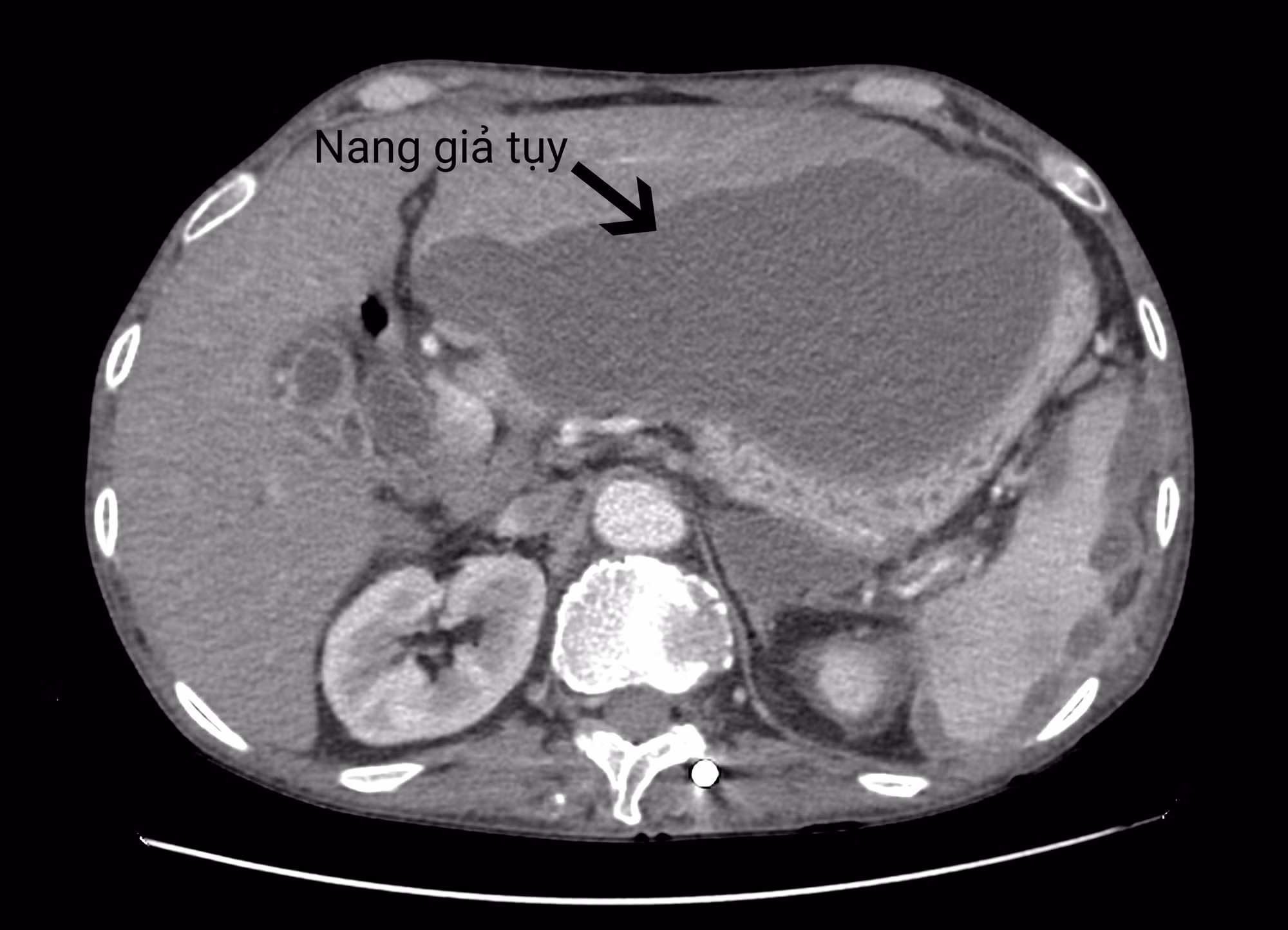Nam bệnh nhân mắc nang giả tụy cực khủng -0