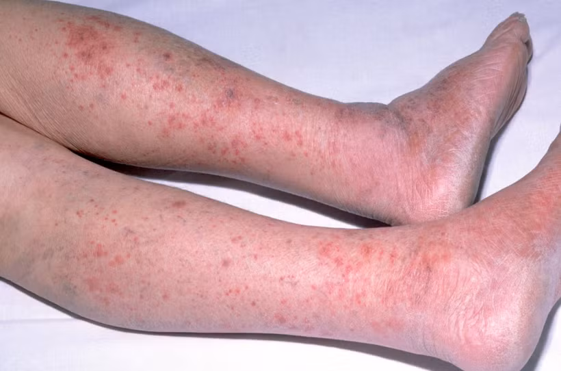 Lo ngại viêm não mô cầu, nhiều người đi tiêm chủng -0