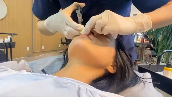 Một cơ sở “thẩm mỹ chui” tiêm filler gây biến chứng