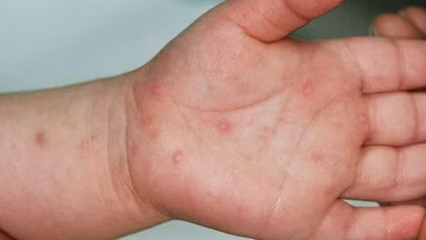 Bệnh tay chân miệng tăng 5 lần, Bộ Y tế hoả tốc yêu cầu ứng phó
