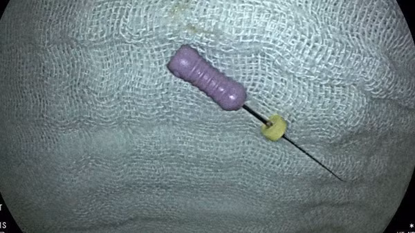 Trẻ 5 tuổi nuốt phải kim nha khoa có kích thước khoảng 2,5cm