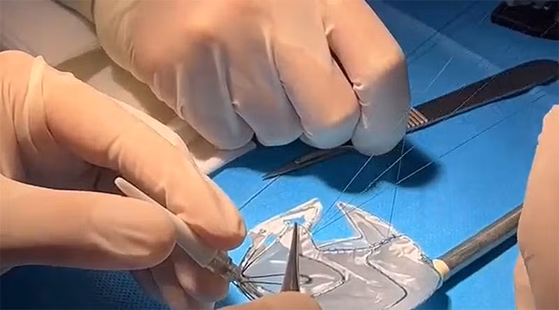 Vinmec áp dụng công nghệ 3D điều trị tim mạch lần đầu tiên ở Đông Nam Á -0