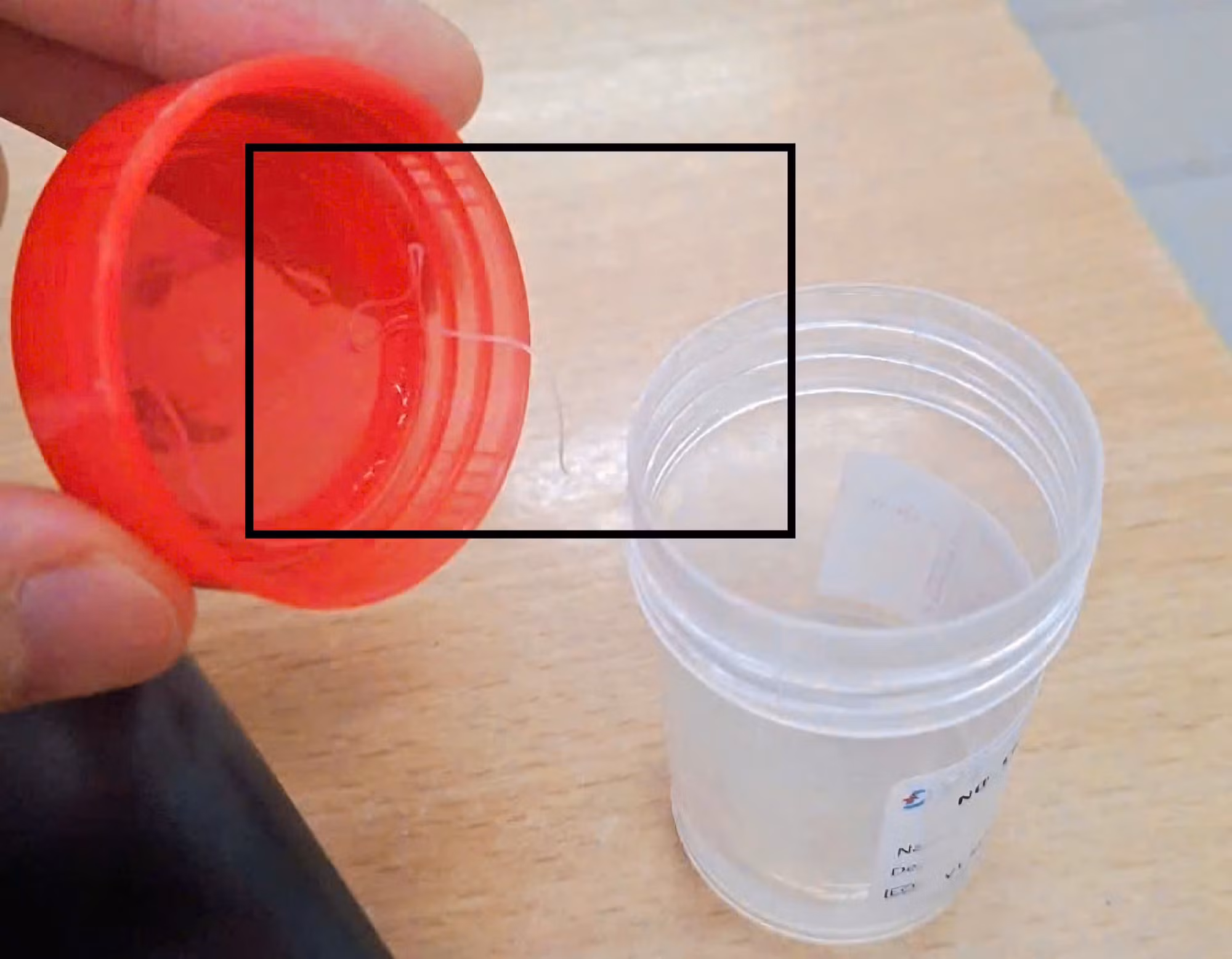 Gắp ký sinh trùng dài gần 10 cm trong mắt người phụ nữ -0