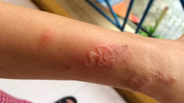 Cụ ông nguy kịch vì nhiễm giun lươn lan toả