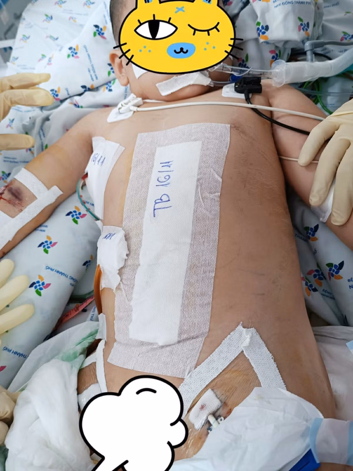Hơn 1,5 tháng nỗ lực cứu bé trai bị đa chấn thương nguy kịch -0