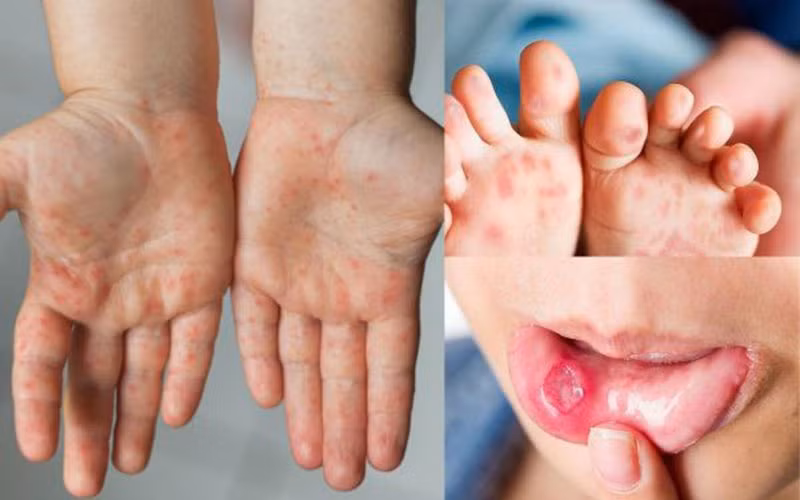 Đã có thuốc điều trị bệnh tay chân miệng nặng -0