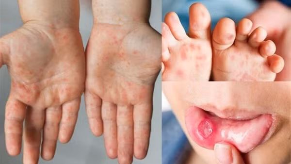 Đã có thuốc điều trị bệnh tay chân miệng nặng
