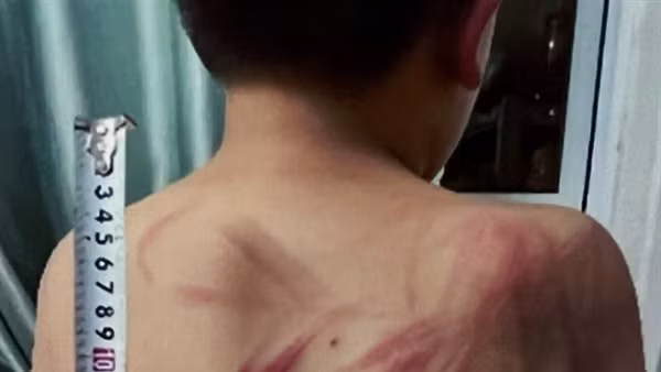 Khởi tố người cha bạo hành con ruột