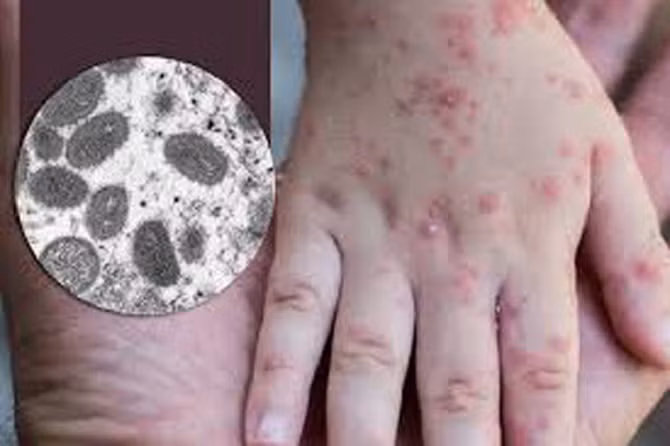 Kích hoạt lại đo thân nhiệt để phát hiện bệnh đậu mùa khỉ -0