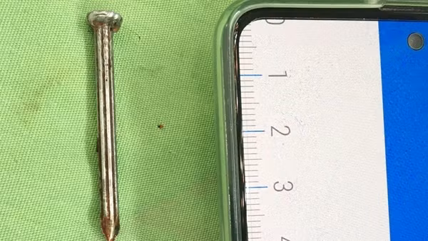 Cứu bệnh nhân bị hóc viên thuốc nguyên vỏ ảnh 4