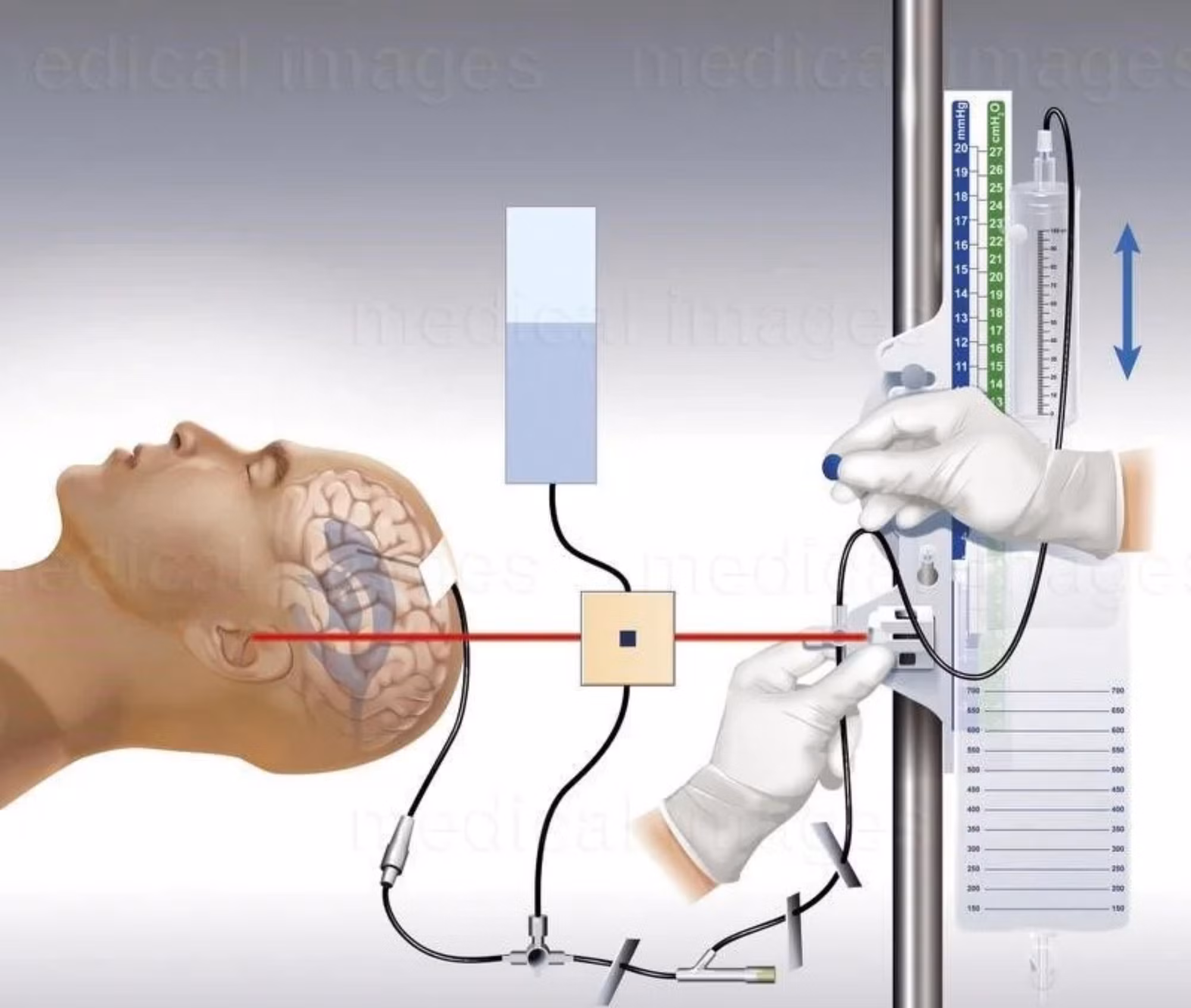 Áp dụng kỹ thuật mới kịp thời cứu sống bệnh nhân đột quỵ não thoát khỏi 