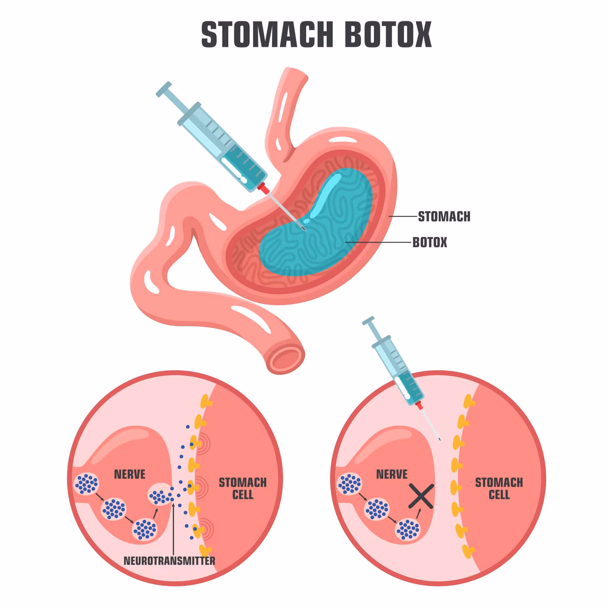 Tiêm chất độc thần kinh botox vào dạ dày làm giảm cân, chống béo phì - bằng chứng chưa thuyết phục -0