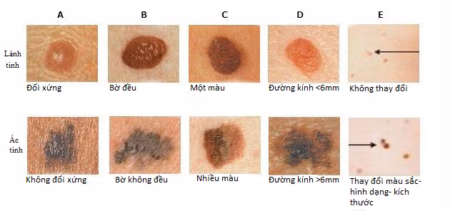 Nhiều người phát hiện ung thư từ vết đen trên da -0