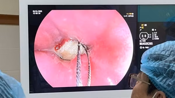Phẫu thuật cứu sống nam thanh niên mắc dị vật sắc nhọn ở thực quản