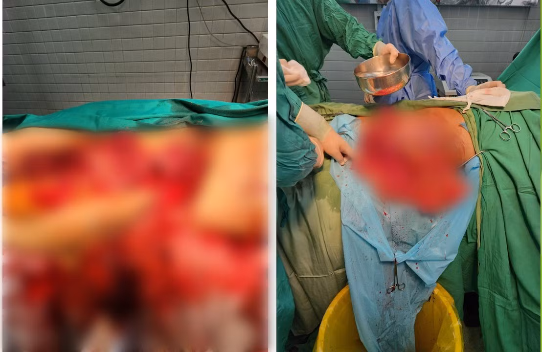 Kỳ tích 11 lần phẫu thuật cứu sống bệnh nhân “ngàn cân treo sợi tóc” -0