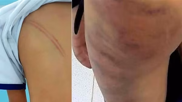 Khởi tố mẹ kế đánh con chồng