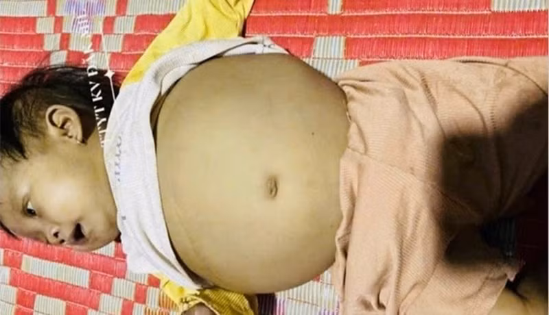 Công an hỗ trợ, kêu gọi giúp đỡ bé gái 17 tháng tuổi mắc bệnh xơ gan -0
