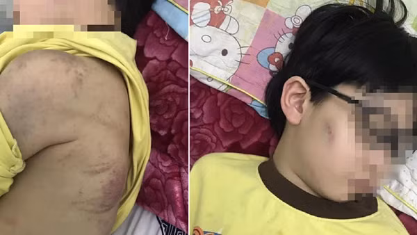 Cháu bé 8 tuổi ở Quảng Ninh bị mẹ bạo hành phải nhập viện