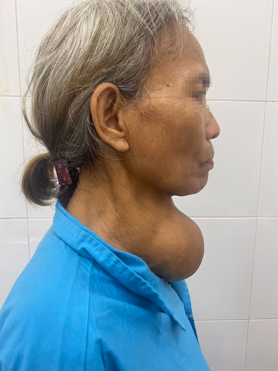 Lấy khối u nặng 1,5 kg “cố thủ” hơn 10 năm trong cổ bệnh nhân -0