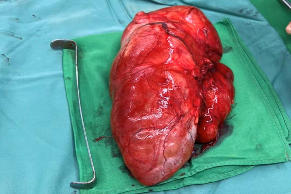  Phẫu thuật bóc tách khối u 3kg ở vùng đùi của một bệnh nhân -0