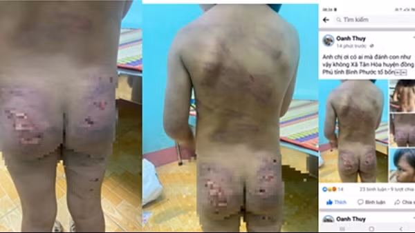 Bé gái 7 tuổi ở Bình Phước nghi bị bạo hành dã man