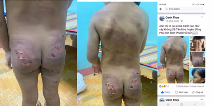 Điều tra bé gái 7 tuổi ở Bình Phước nghi bị bạo hành -0