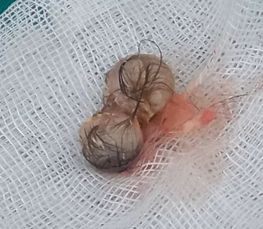 Cô gái 22 tuổi mắc u quái buồng trứng nguy kịch, cảnh bảo căn bệnh viêm não tự miễn -0