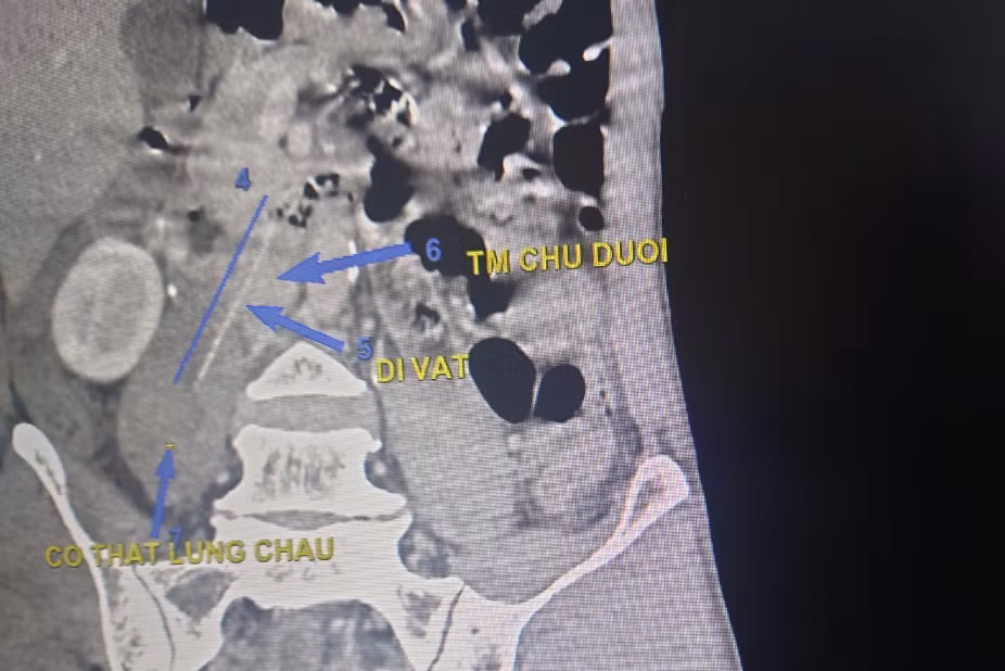 Ngậm tăm đi ngủ, người đàn ông bị thủng ruột non -0