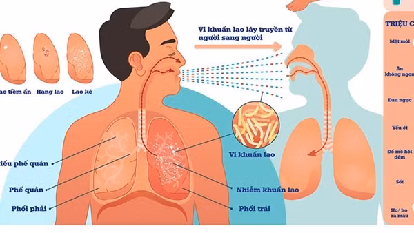 Khoảng 13 nghìn người tử vong vì bệnh lao mỗi năm, Thủ tướng chỉ đạo tăng cường phòng, chống