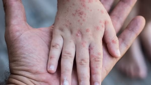 Giám sát chặt bệnh sởi, rubella