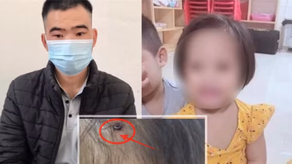 Hành trình điều tra, lật mặt kẻ đóng đinh vào đầu cháu bé 3 tuổi ảnh 2