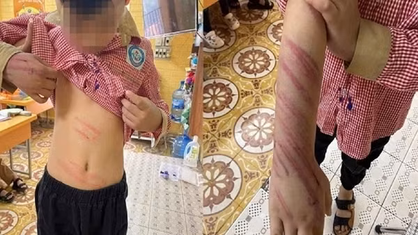 Bố dượng bạo hành con riêng của vợ khai “bức xúc vì cháu nó hay trộm tiền”