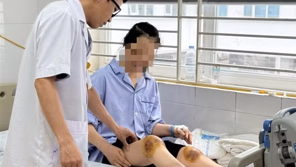 Dùng ong đốt vào đầu gối chữa bệnh, người phụ nữ bị hoại tử cẳng chân