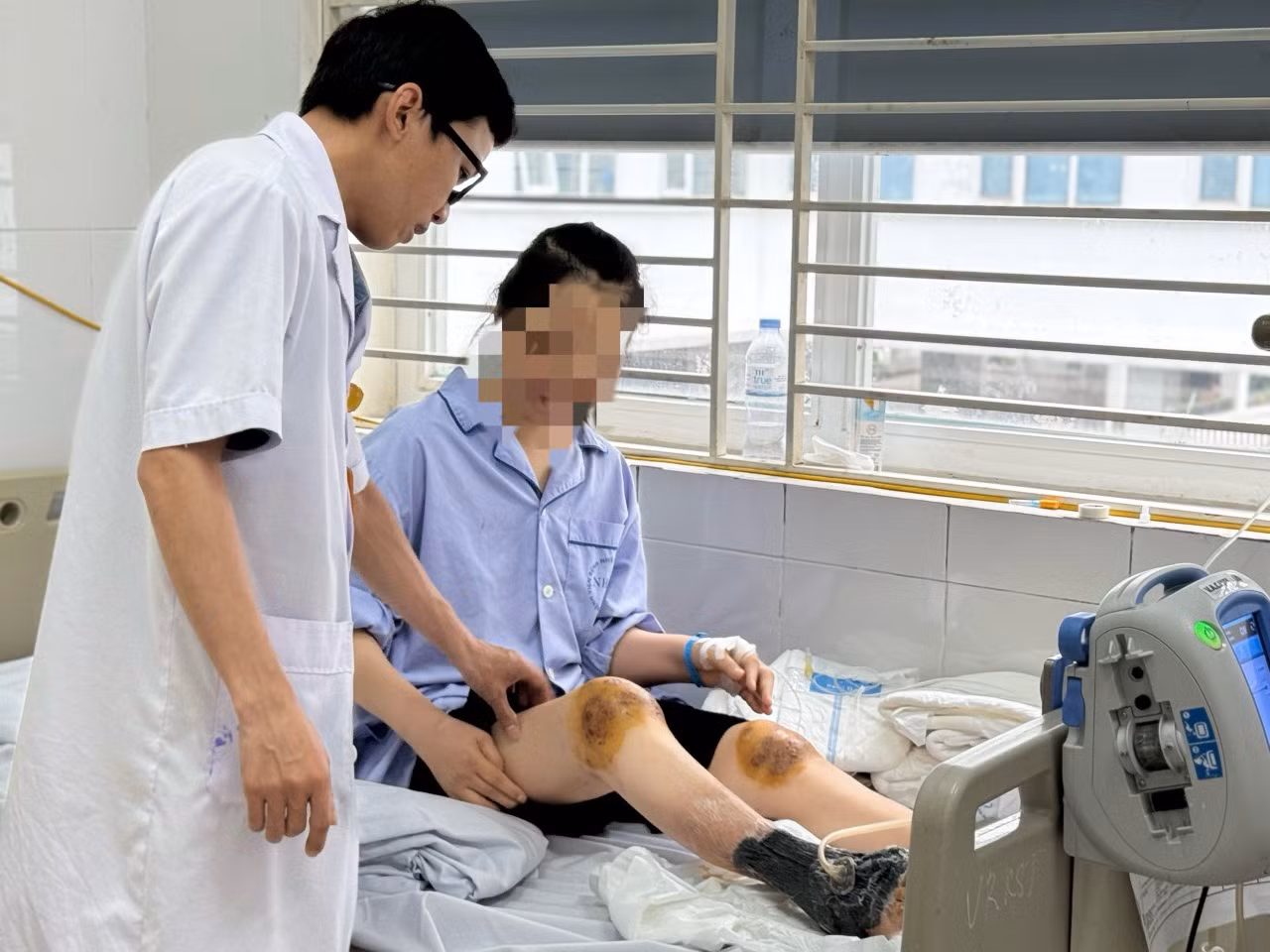 Dùng ong đốt vào đầu gối chữa bệnh, người phụ nữ bị hoại tử cẳng chân -0
