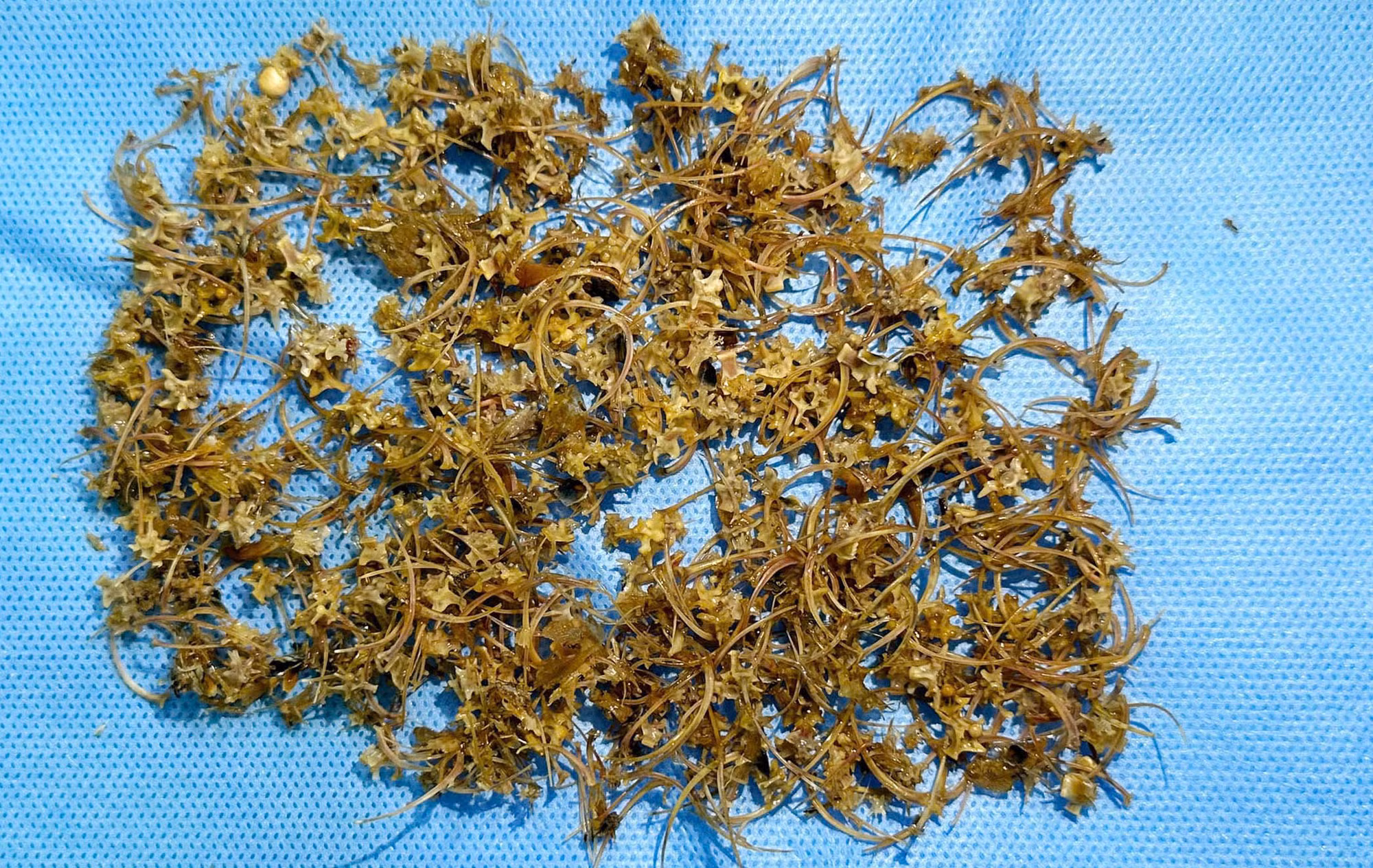 Cấp cứu kịp thời một bệnh nhân nuốt hàng ngàn mảnh xương rắn -1