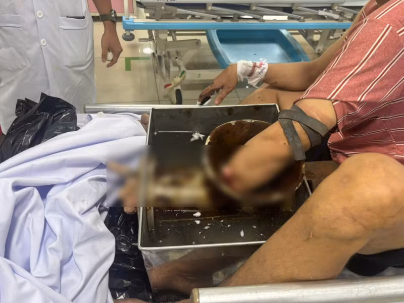Nguy cơ tiềm ẩn và hậu quả khó lường từ máy xay thịt -0
