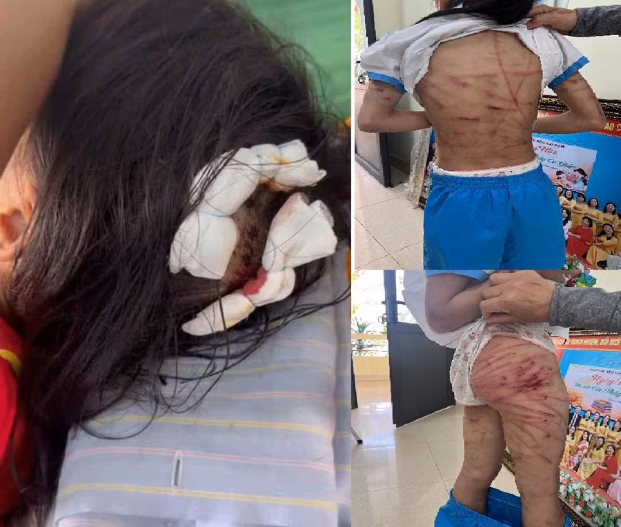 Bắt khẩn cấp cha dượng bạo hành dã man con riêng của vợ -0