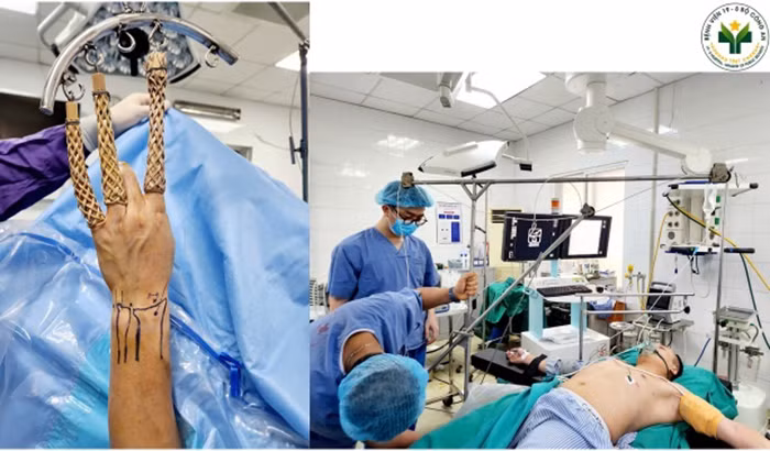 Bệnh viện 19-8 phẫu thuật nội soi nối rách đĩa sụn sợi tam giác cổ tay với trợ cụ đặc biệt tự tạo -0