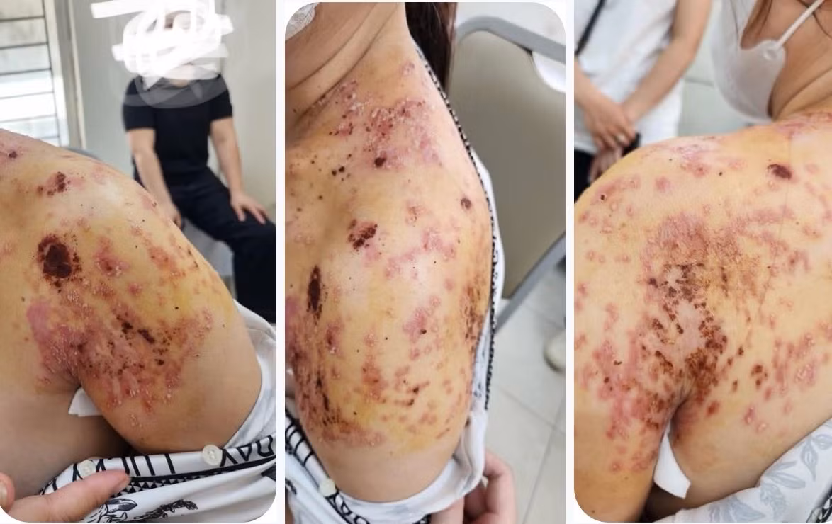 Bó lá điều trị gãy xương đòn, người phụ nữ ở Hà Nội bị bỏng da và nhiễm trùng da nặng vì bó lá -0