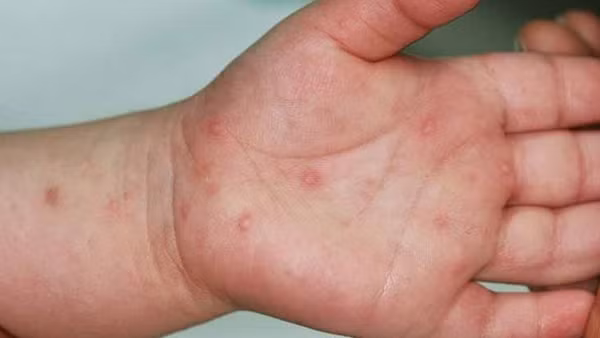 Bộ Y tế yêu cầu tăng cường theo dõi người bệnh tay chân miệng