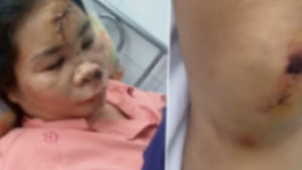 Xác minh thông tin vụ cướp giật khiến người phụ nữ bị chấn thương sọ não