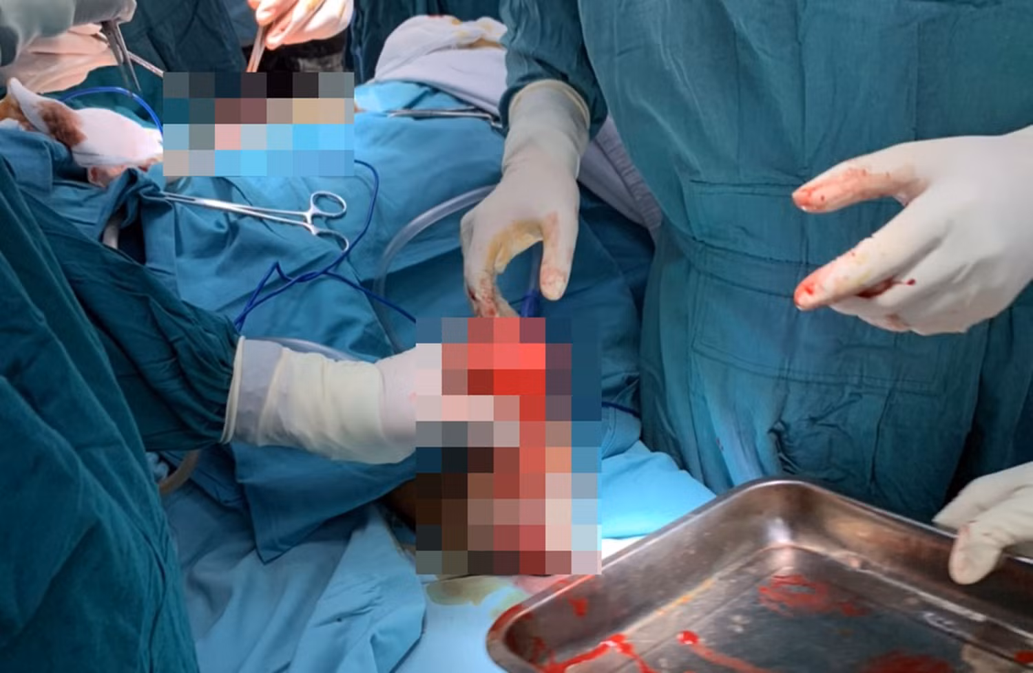 Nam thanh niên bị thương nặng 2 bàn tay vì vật liệu nổ -0