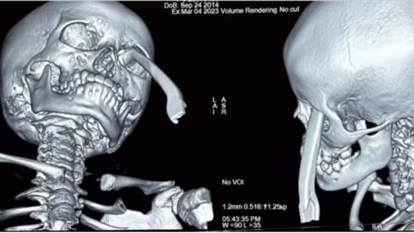 Hai bệnh viện “báo động đỏ” cấp cứu trẻ bị tay thắng xe đâm vào hốc mắt