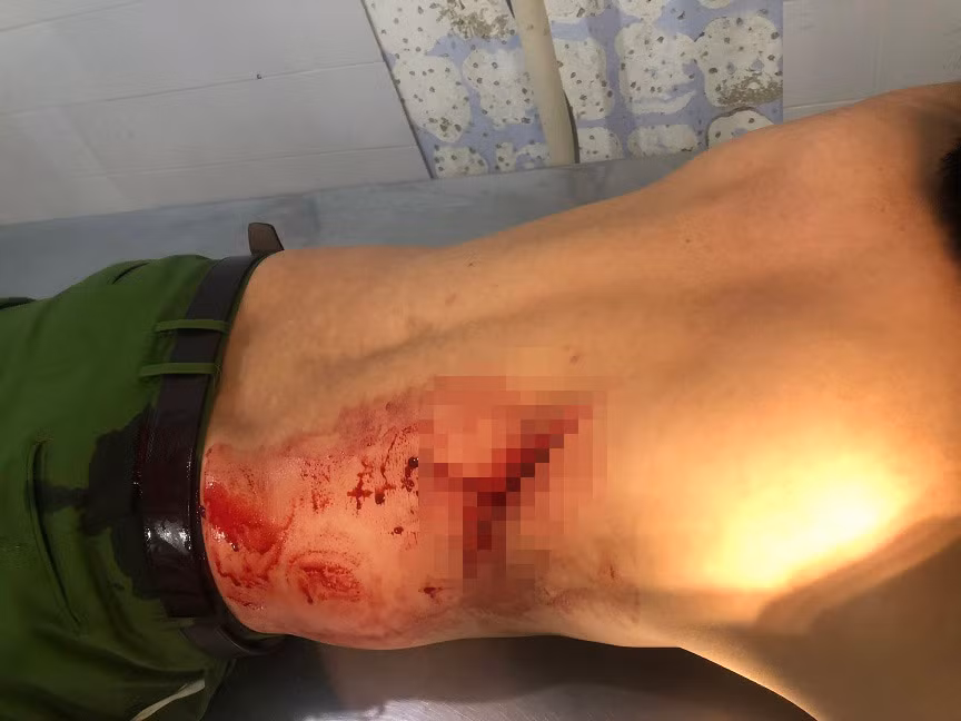 Hai cán bộ công an xã bị thương khi làm nhiệm vụ -0